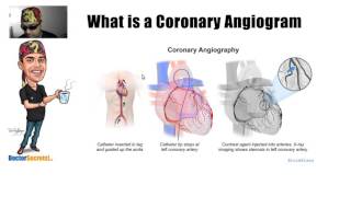 What is a Coronary Angiogram Explained Simply [upl. by Magdau]