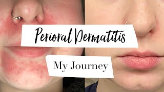 How I Treated My Perioral Dermatitis  MY JOURNEY [upl. by Gnehc]