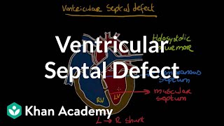 Ventricular septal defect  Circulatory System and Disease  NCLEXRN  Khan Academy [upl. by Acherman]