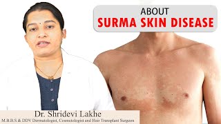 Surma Skin Disease  सुरमा कारण और उपाय   Tinea Versicolor Treatment by HealthFirst All in 1 [upl. by Drake]