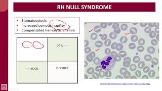 Hematology  4  U1L41  Rh null syndrome [upl. by Bolen]