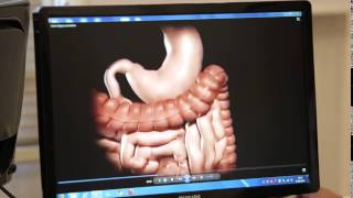 Gastrik Bypass Ameliyatı Nedir ProfDr Oktay Banlı [upl. by Aisyla]