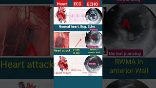 Heart attack vs Heart fail ecg  echo l ecg echo shorts [upl. by Baun635]