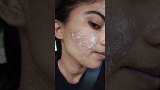 Transforming My Skin  Acne Scars Journey Laser Treatment skincare shorts [upl. by Darci459]