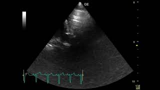 ESTENOSIS PULMONAR [upl. by Gorden841]