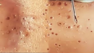 Satisfying and relaxing blackhead removal 2024  Pimples Removal home remedies  Blackheads [upl. by Hayes880]