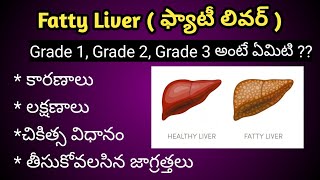 Fatty Liver Gradesఫ్యాటీ లివర్Symptoms and Treatment in Telugu [upl. by Ikram902]