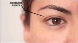 Information on Blepharoplasty  Dr Bryan Mendelson [upl. by Cower]