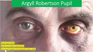 Pupil abnormality series lecture 4  Agryll robertson pupil VS adies tonic pupil [upl. by Helmer]