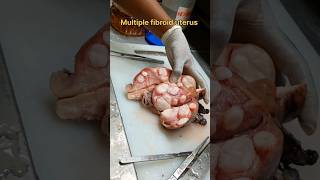 Multiple fibroid uterus specimen [upl. by Freberg]