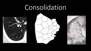 Chest Radiology  Patterns  Airspace [upl. by Ijuy71]