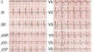 elettrocardiogrammasecondapartewmv [upl. by Emerej]