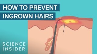 What Are Ingrown Hairs — And How To Treat Them [upl. by Cinimod631]