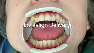 Invisalign Delivery [upl. by Farrow]