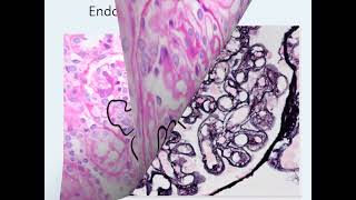 شرح عربي Membranoproliferative Glomerulonephritis Practical session [upl. by Loralee]