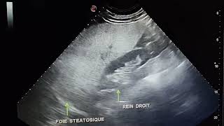 Échographie abdominale Stéatose hépatique diffuse Hepatomegalie FH a 215 mm [upl. by Sset]