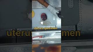 Uterus specimen grossing tissuefixation kidneydisorder cystickidneydisease [upl. by Acyssej441]