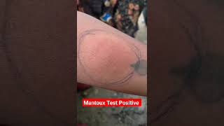 Mantoux Test Result Positive shortsyoutubeshorts virulshorts [upl. by Persian]