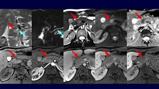 Preview Pancreatic mass with ill defined margin and main duct dilatation [upl. by Akinahc]