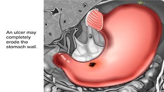 How Stomach Ulcers Form Animation  Peptic Ulcer Disease Causes Symptoms and Treatments Video [upl. by Sabanrab827]