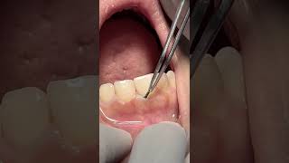 Retraction cord dentist satisfying [upl. by Salchunas]