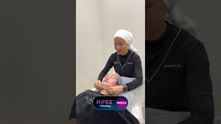 Neck Rejuvenation with BTL Emface Submentum [upl. by Otxis213]