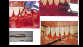 Gingivectomy amp Gingivoplasty [upl. by Weksler]