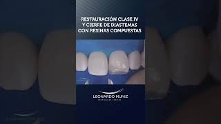 Restauración Clase IV y Cierre de Diastema con Resinas Compuestas [upl. by Esiom61]