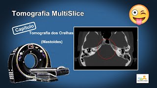 Tomografia dos Orelhas Mastoides Dicas e Truques [upl. by Ashatan]