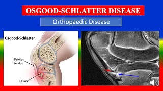 OSGOOD SCHLATTER DISEASE  Definition types causes pathophysiology signs amp symptoms medicine [upl. by Nosnah]