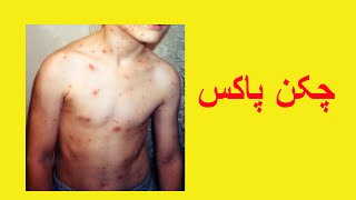 Chicken Pox Information in Urdu [upl. by Krisha750]