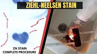 Ziehl Neelsen StainAcid Fast StainZN StainZiehl Neelsen Stain ProcedureAdnanMLT [upl. by Aihsein]