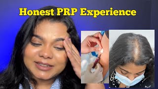 Honest PRP Experience  ₹60000 for Hair Growth Does PRP grow hair back Honest experience [upl. by Caassi23]