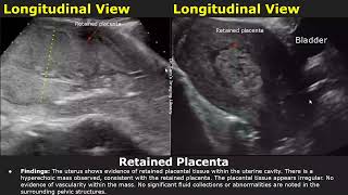 Postpartum Uterus Ultrasound Reporting  RPOCRetained Placenta Scan Reports  Pelvic USG [upl. by Margalit991]