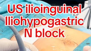 US guided Ilioinguinal iliohypogastric ns block [upl. by Ylrebme]