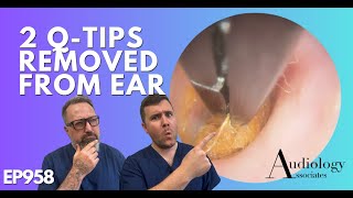 2 QTIPS REMOVED FROM EAR  EP958 [upl. by Aholla]