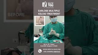 Multiple Keloid Treatment  Ear Keloid Treatment in Delhi  Dr PK Talwar [upl. by Felicie]