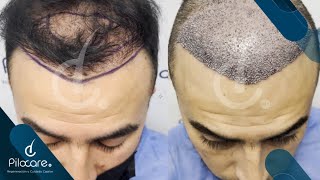 Injerto de cabello  Regeneración frontal hair line y entradas  y coronilla  Técnica FUE  CDMX [upl. by Nirrad]