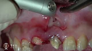 Restorative Crown Lengthening in Esthetic Zone amp Apicoectomy with Giuded Tissue Regeneration IV [upl. by Vasta189]