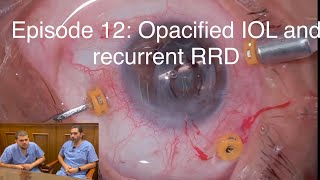 Retina Chats Episode 12 Opacified IOL and recurrent retinal detachment [upl. by Swigart]