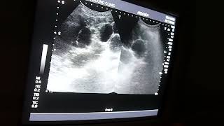 ultrasound liversimple hepatic cysts [upl. by Esac]