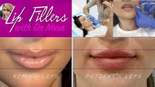 Lip Filler Treatment for quotPerfectquot Kim Kardashian Inspired Lips  Gold Coast 💋 [upl. by Darn]