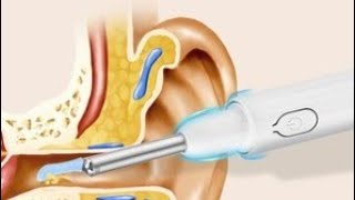 Ear cleaning camera incredible image [upl. by Sylirama]