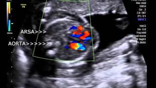 ARSA  aberrant Right subclavian artery in fetus 18 weeks [upl. by Herwick]