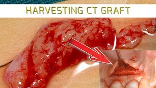 Ep 17 PART 1  HOW TO HARVEST CONNECTIVE TISSUE GRAFT [upl. by Eilliw90]