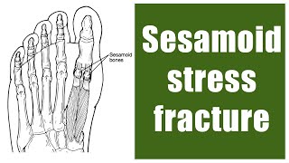 Sesamoid stress fracture surgery in runners [upl. by Stephanie]