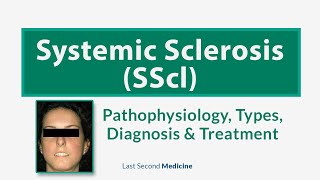 Systemic Sclerosis SScl  Scleroderma  Types Pathophysiology Diagnosis amp Treatment of SScl [upl. by Ilahtan657]