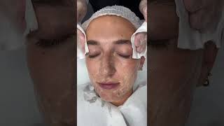 Benefits of Mandelic Acid Skin Peels  Dr Medispa [upl. by Sewoll841]