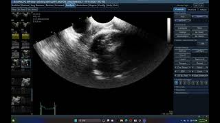 5590 TCDTRANSCRANIAL DOPPLER ECHOPAC BRAIN PDH ICP CPP THROMBUS SMALL ANIMAL [upl. by Banks237]