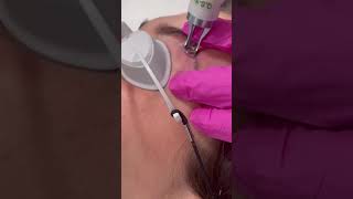 Tattoo eyebrow removal  Dr Medispa [upl. by Hgierb]